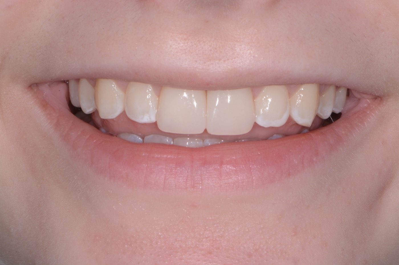 Case 43 after photo 1