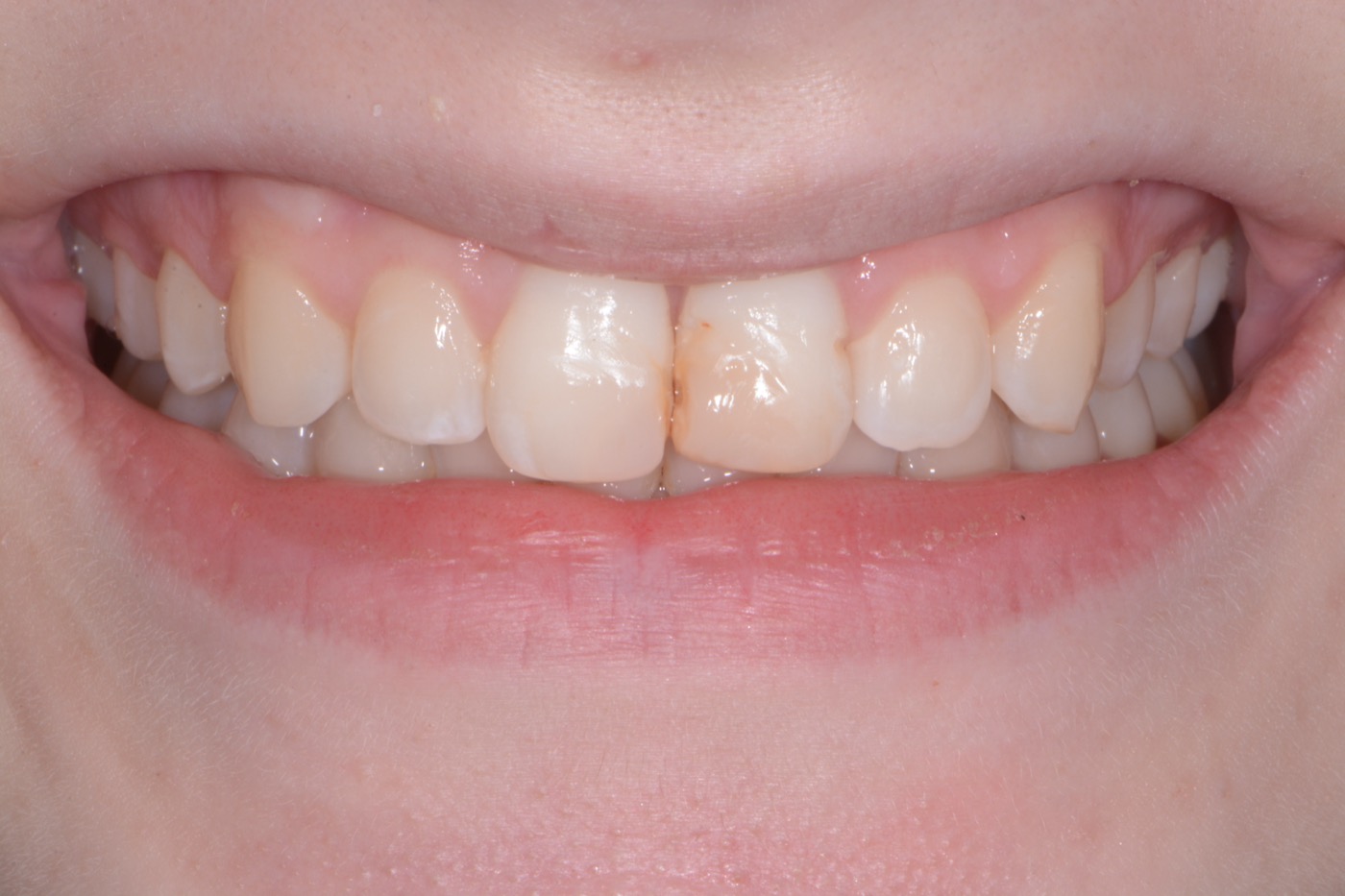 Case 43 before photo 1