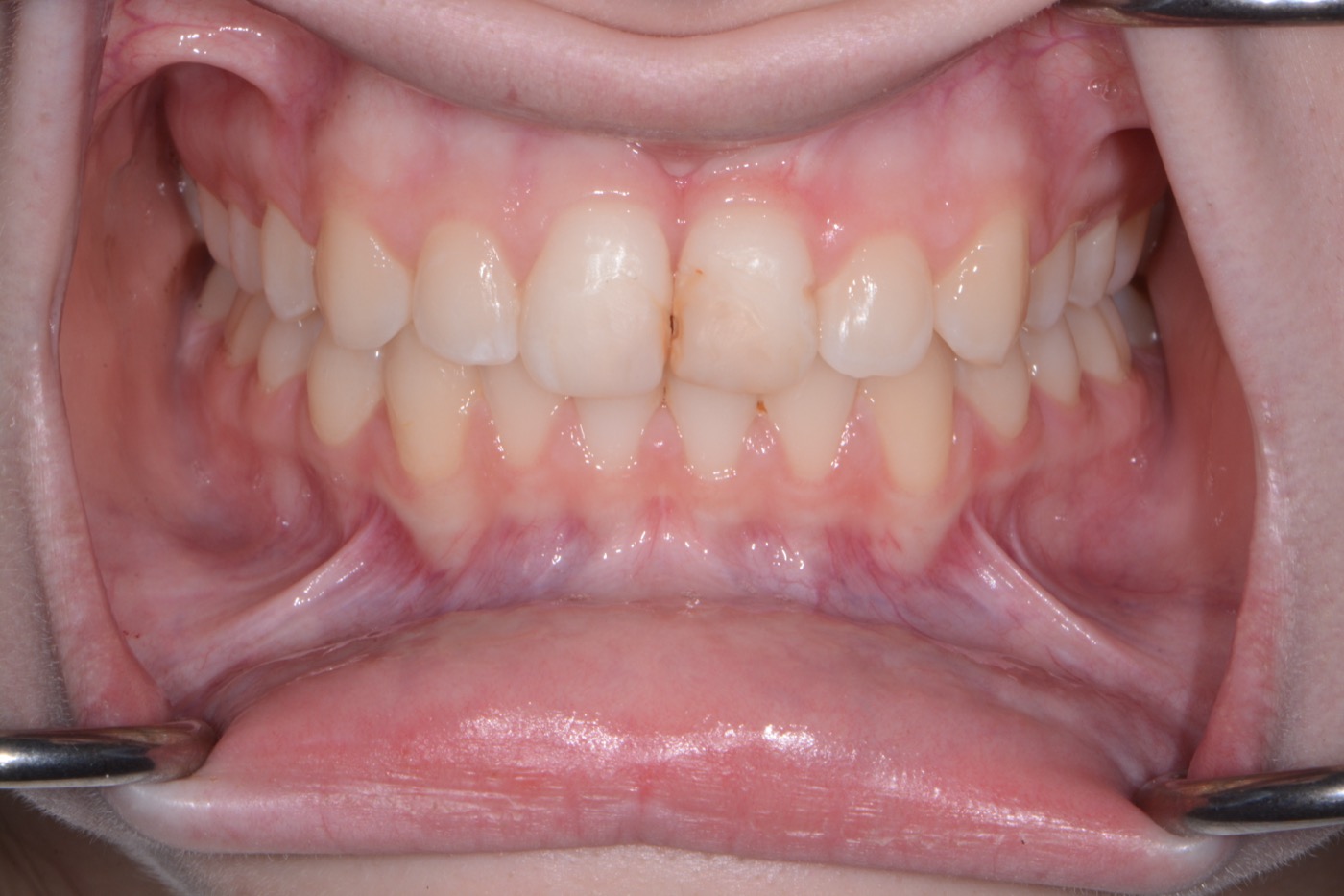 Case 43 before photo 2