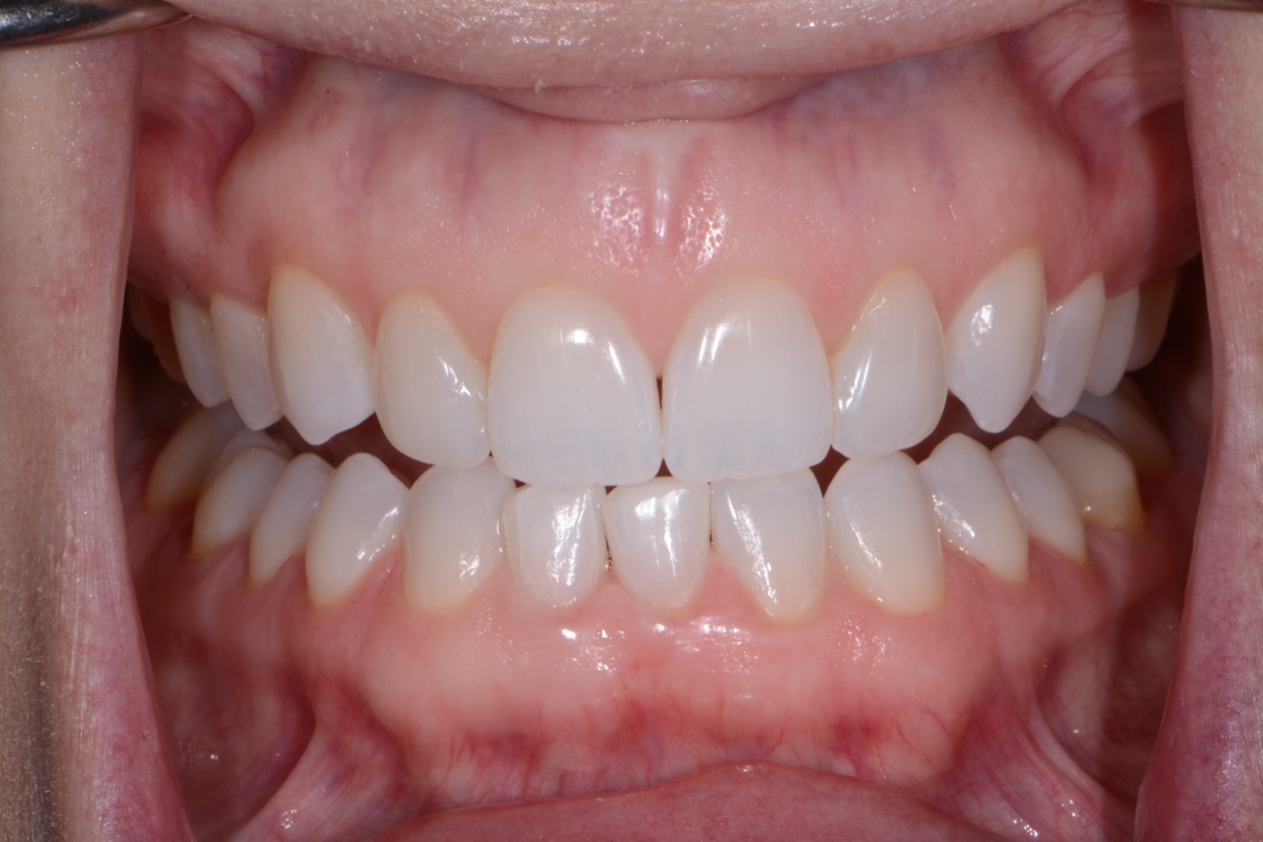 Case 44 after photo 2