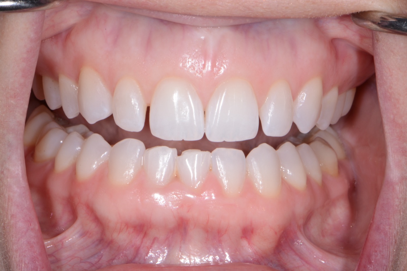 Case 44 before photo 2