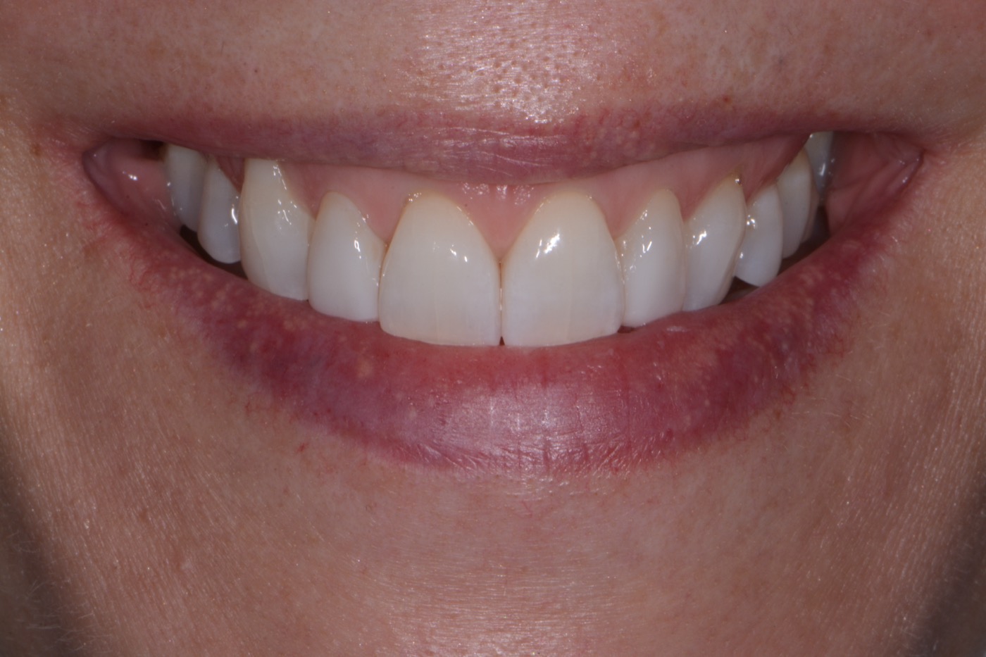Case 45 after photo 1