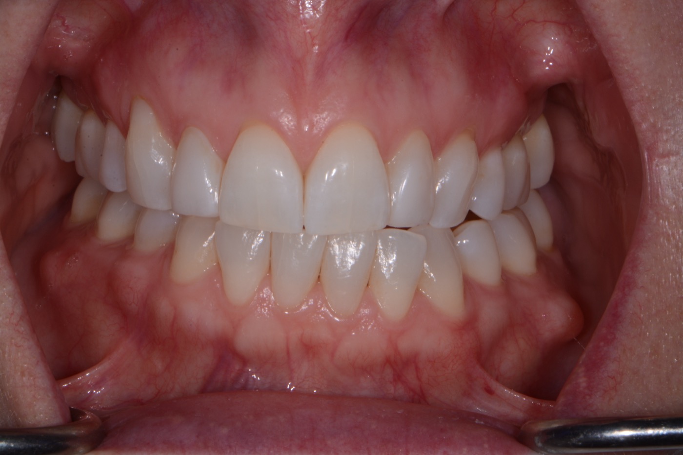 Case 45 after photo 2