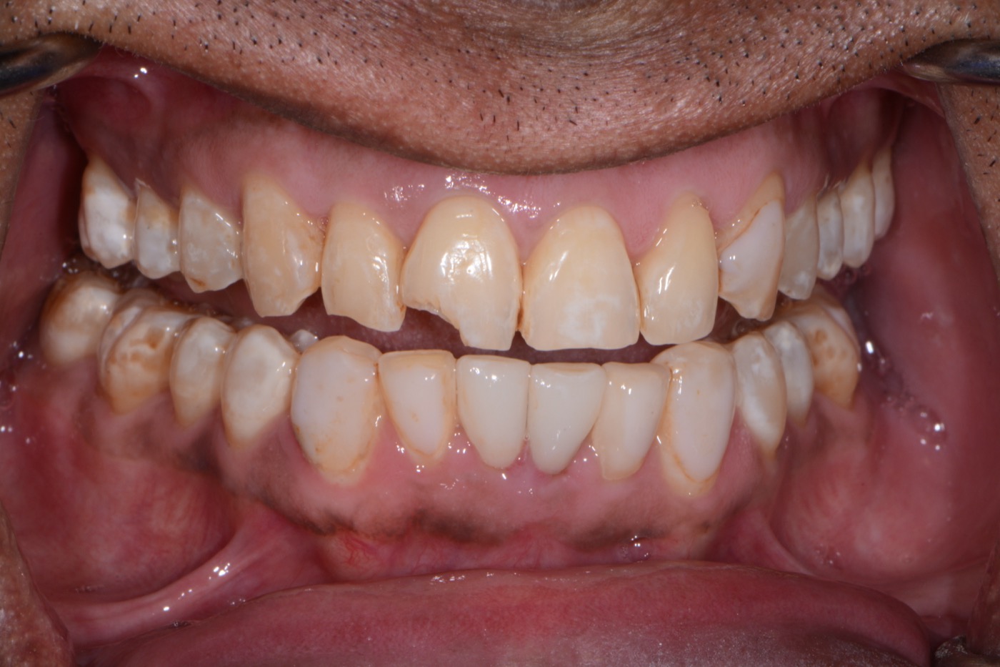 Case 46 before photo 2
