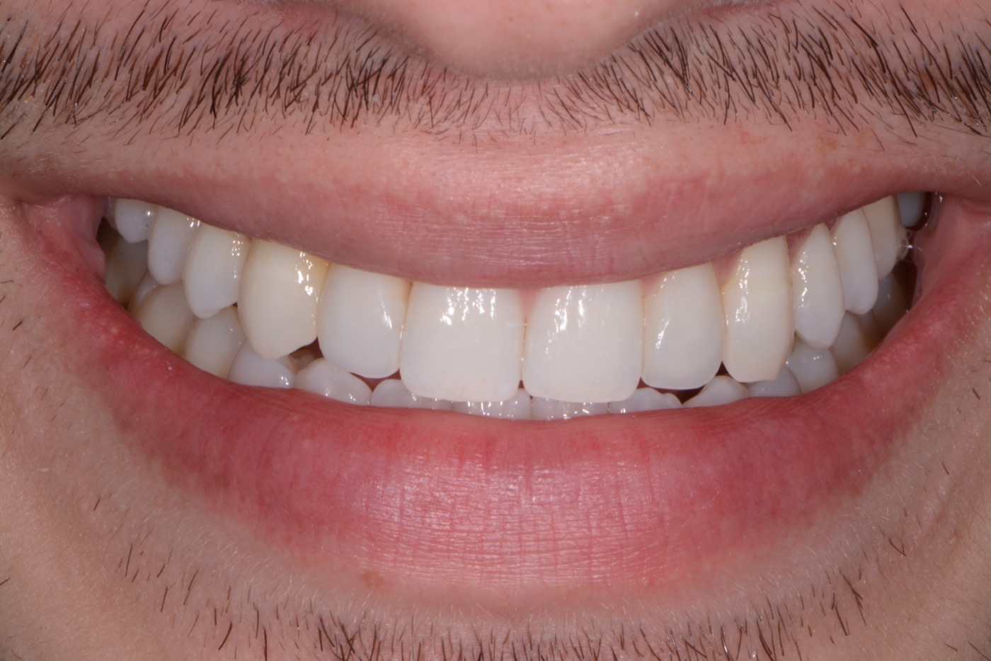 Case 47 after photo 1