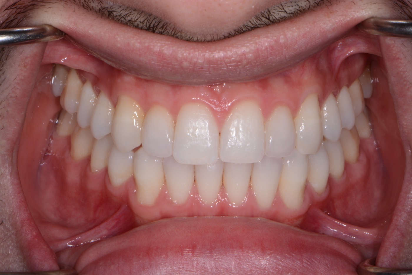 Case 47 after photo 2