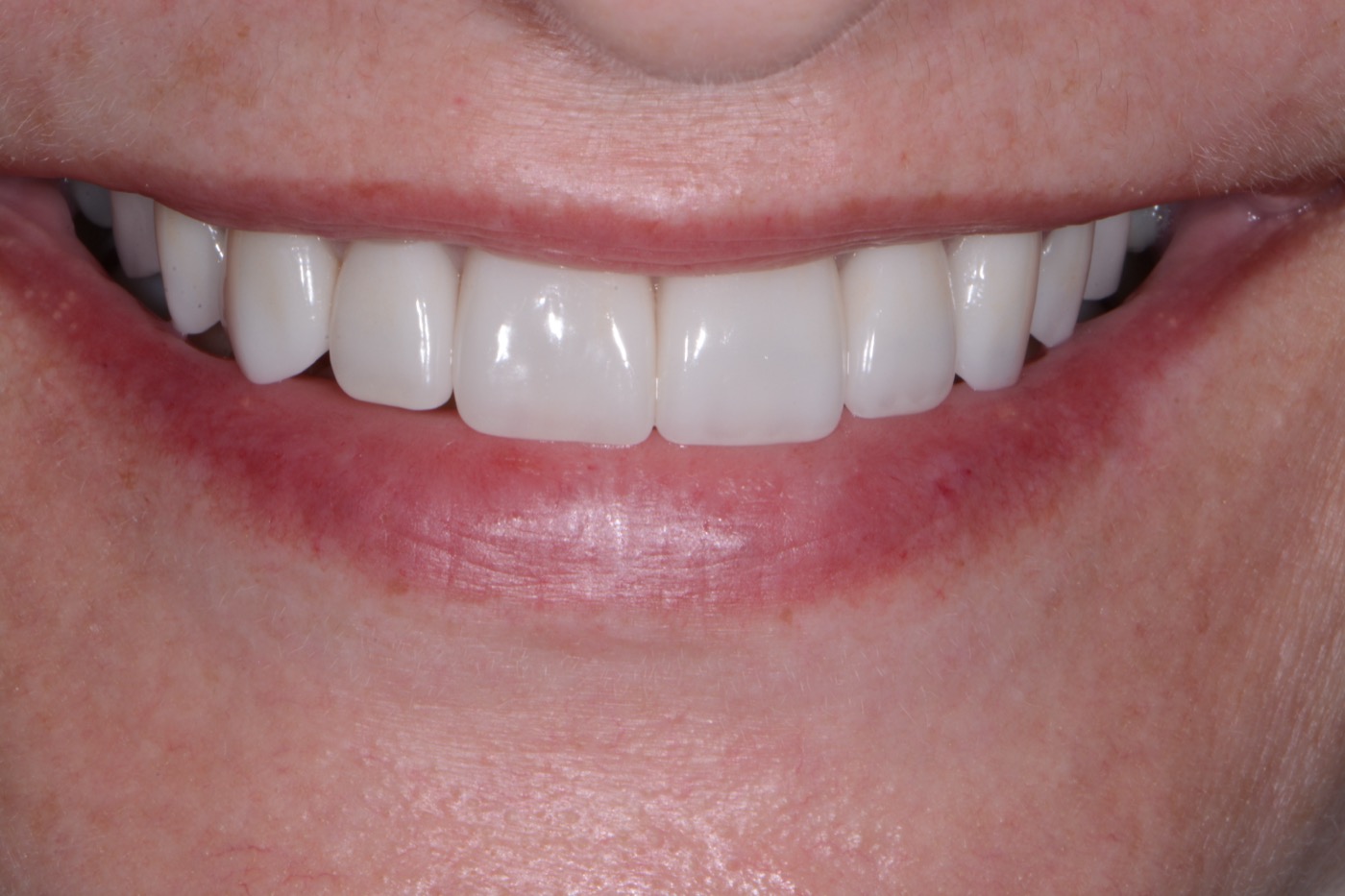 Case 48 after photo 1