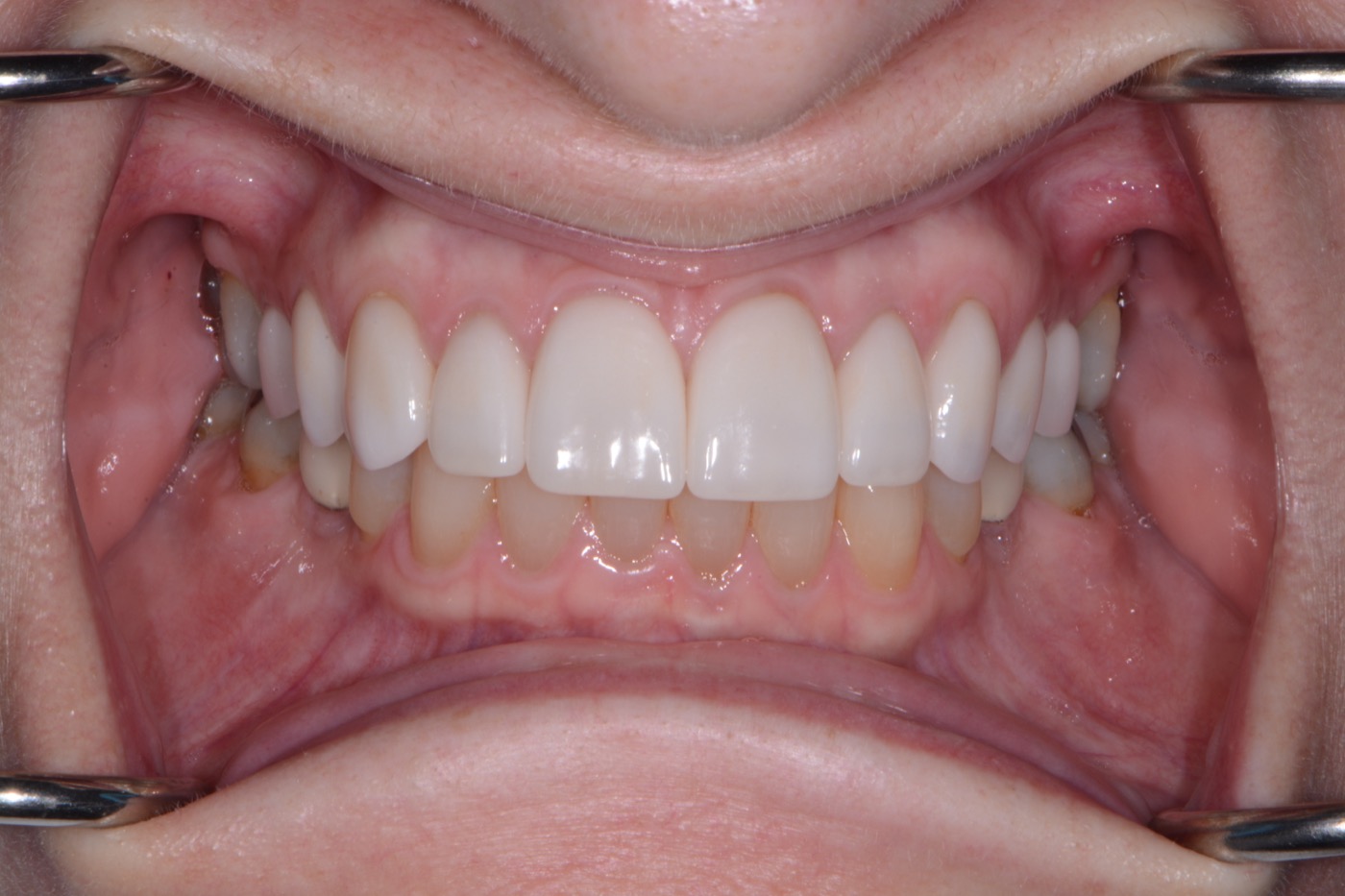 Case 48 after photo 2